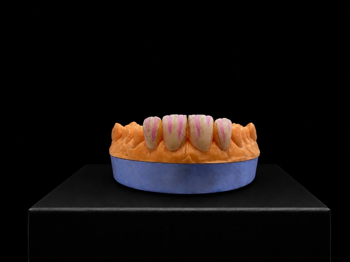 Anterior zirkonya restorasyonda renk ve karakterizasyon